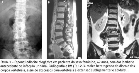 Scielo Brasil Diagnóstico Por Imagem Nas Espondilodiscites