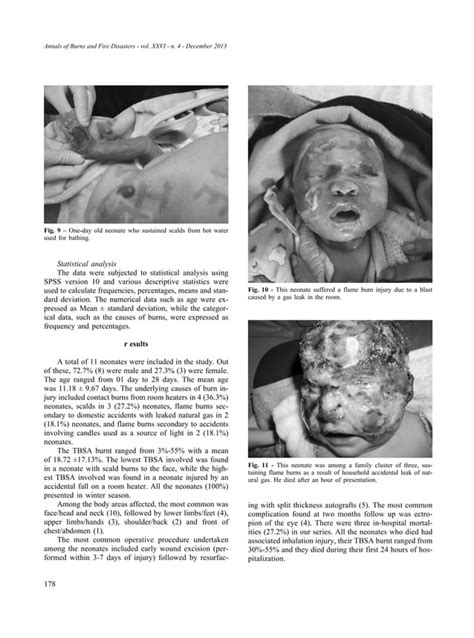 Neonatal Burns Pdf