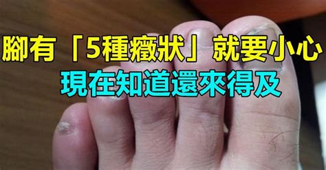 是中風的先兆！腳有5種「症狀」就要小心了 無論男女「腳麻」現在知道還來得及 讀讀