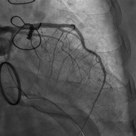 Postoperative coronary angiogram shows occlusion in the left circumflex ...