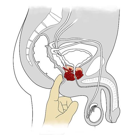 1,100+ Prostate Exam Stock Illustrations, Royalty-Free Vector Graphics & Clip Art - iStock