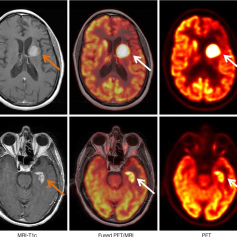 Representative Cases Of Primary Cns Lymphoma On Cxcr Directed Pet And