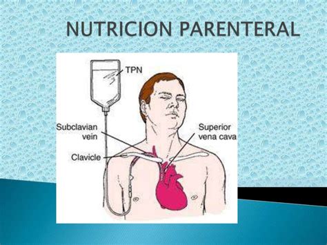 Nutrición Enteral y Parenteral