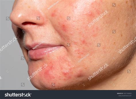 Face Girl Skin Diseases Acne Demodicosis Stock Photo 1521192923