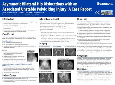 Asymmetric Bilateral Hip Dislocations With An Associated Unstable Pelv