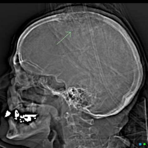 Skull Vault Hemangioma Image Radiopaedia Org