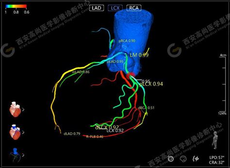 医学影像之冠状动脉ct血流储备分数ai定量分析（ct Ffr）冠状动脉医学影像分析 健康界