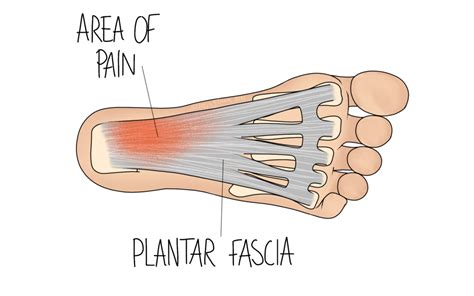 Plantar Fasciitis Wiltshire Osteopathy