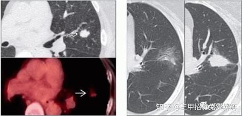 肺腺癌与鳞癌的10个经典ct征象 建议收藏 知乎