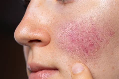 Different Types Of Rosacea And Treatments Sk N Clinics