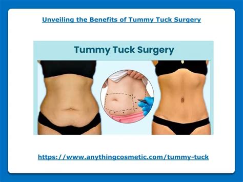 Ppt Unveiling The Benefits Of Tummy Tuck Surgery Powerpoint