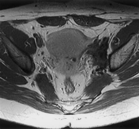 Mr Imaging Of Common And Uncommon Large Pelvic Masses Radiographics