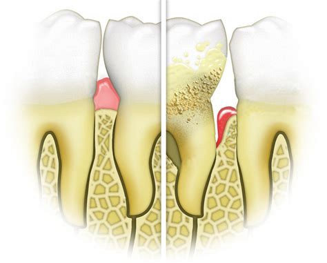 Periodontal Surgical Treatment Methuen Periodontics And Implant Dentistry