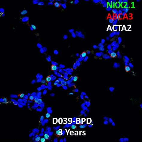 3 Year Human Lung NKX2 1 ABCA3 And ACTA2 Confocal Imaging