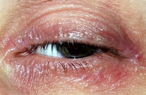 Itchy Hives Around Eyes