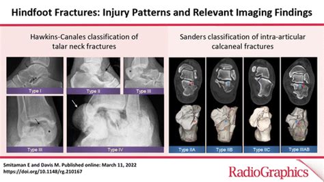 Calcaneus Fracture Classification