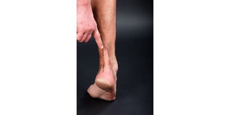 Tendinitis De Aquiles Causas Síntomas Y Tratamiento