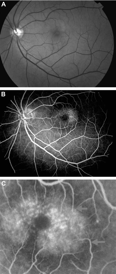 Figure 1 From Idiopathic Macular Telangiectasia Type 2 Idiopathic