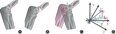 Illustration Of The Gartland Iia Supracondylar Fracture Scf Model On