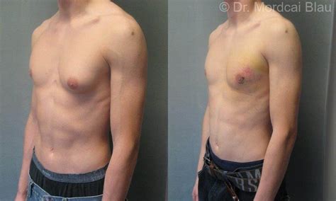 Unilateral Gynecomastia Before And After Photos ⋆ Gynecomastia Usa