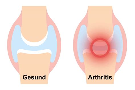 Arthritis Symptome Auslöser Therapie Schwabe Austria