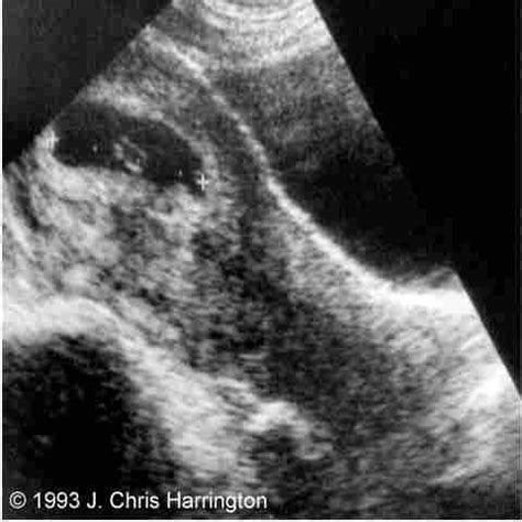 Heterotopic Pregnancy