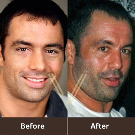 Joe Rogan Hair Transplant Before And After Transformation