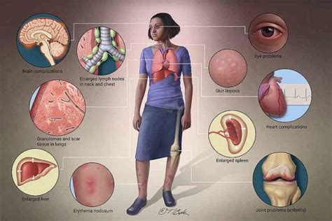 Sarcoidosis - MedEd Center