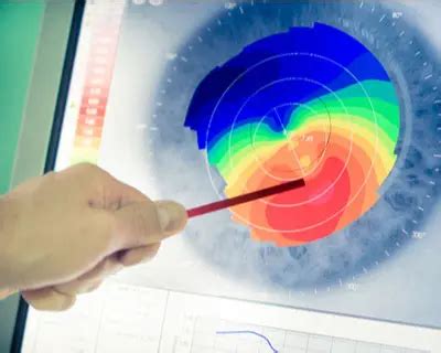 Corneal Topography - American Academy of Ophthalmology