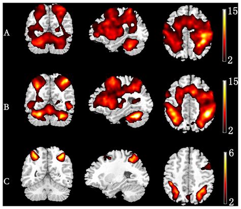 Group Level Activation Map In Different Memory Load A 1 Back