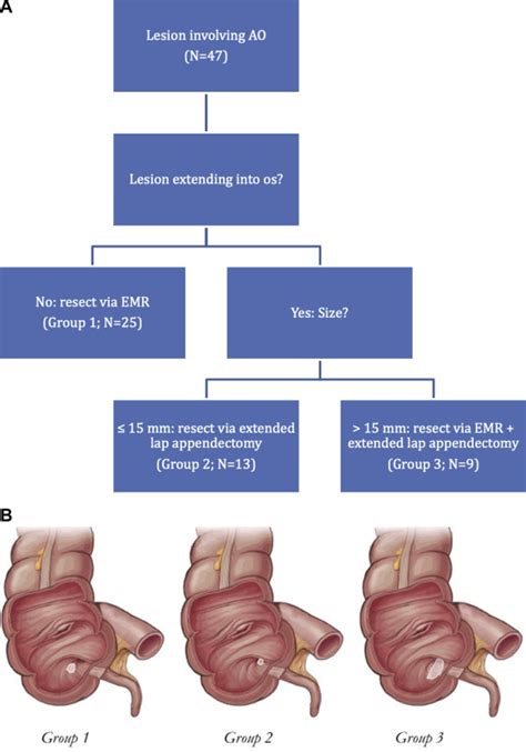 Combined Endoscopic Mucosal Resection And Extended Laparoscopic