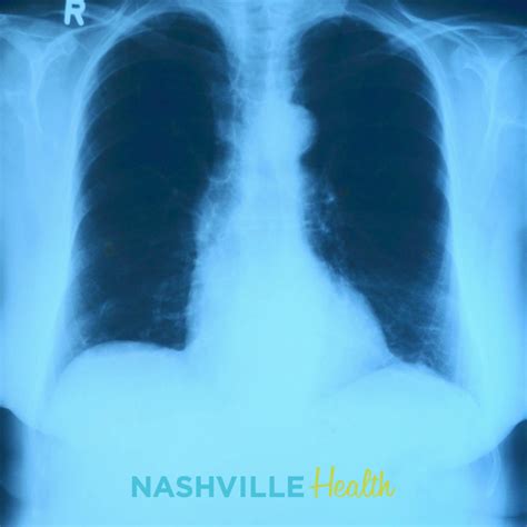 Lung Health after Smoking Cessation | NashvilleHealth