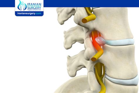 Lumbar Radiculopathy | Iranian Surgery