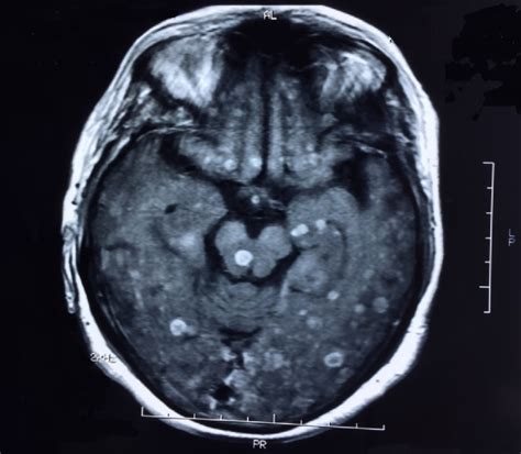 Brain Lesions Mri