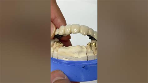 Pfm Pontic Bridge Dental Teeth Smile Lsk121shorts Shortvideo