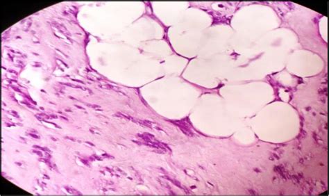 Figure 1 From Uterine Lipoleiomyoma A Rare Variant Of Benign Uterine