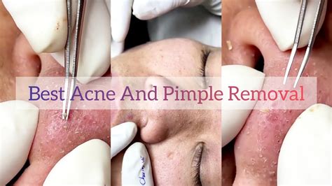 ASMR Best Acne Asmr Best Pimple Asmr Removal Of Pimple And