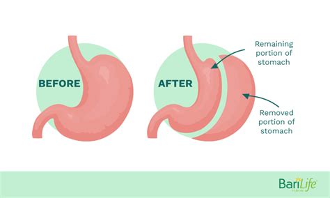 Gastric Sleeve Vs Gastric Bypass What Are The Pros And Cons