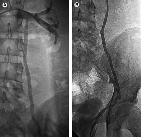 Pediatric Varicocele Embolization Techniques In Vascular