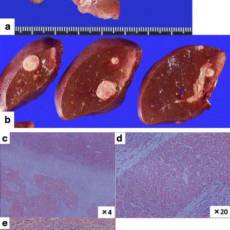 Macroscopic And Histological Findings Of The Resected Specimen The