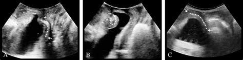 —Anterior (A), apical (B) and global (C) cystocele recurrences after... | Download Scientific ...