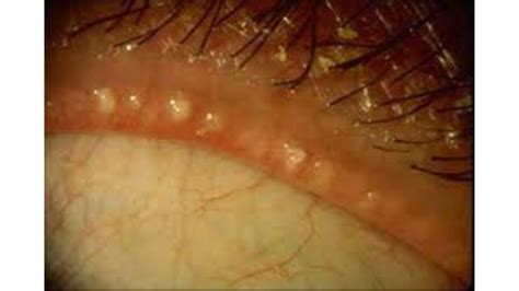 Meibomian Gland Dysfunction (MGD): Causes & Treatment Options