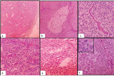 A Well Circumscribed Dermal Tumor Cystic Spaces Clear