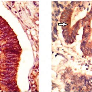 Pure Cytoplasmic Pattern Of Expression Of CASK In Colon Adenocarcinoma