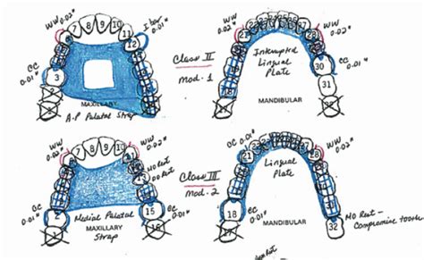 Drawing Removable Partial Denture Design – Otosection