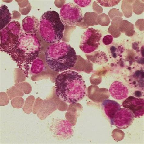 Bone Marrow Aspiration Showed Moderate Hyperplasia Of The Myeloid