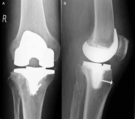 Frontiers Therapy Of Chronic Extensor Mechanism Deficiency After