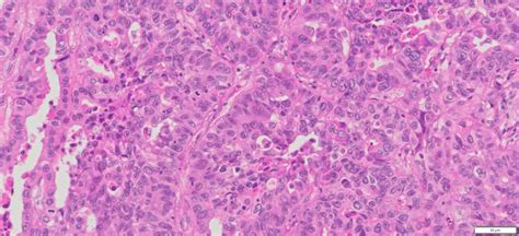 Human Lung Adenocarcinoma FFPE Sections