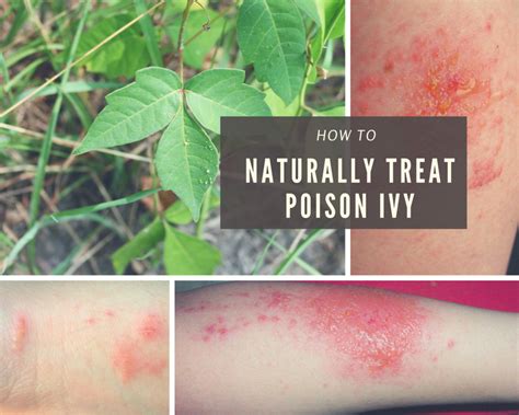 How To Treat Poison Ivy Fast