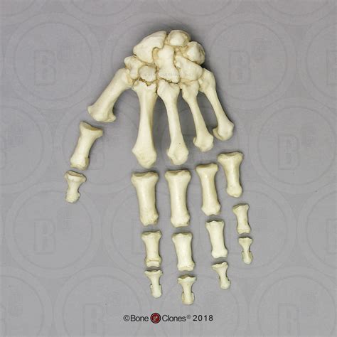 Human Female Achondroplasia Dwarf Hand Semi Articulated Bone Clones